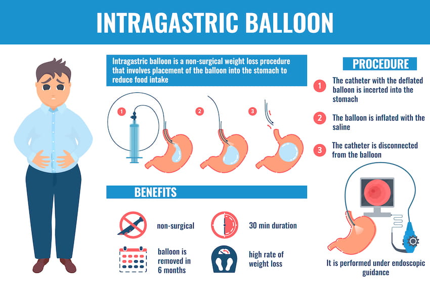 intragastric balloon infographic